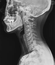 최근 5년간 일자목증후군 질환 30만명 증가…연평균 2.4%↑